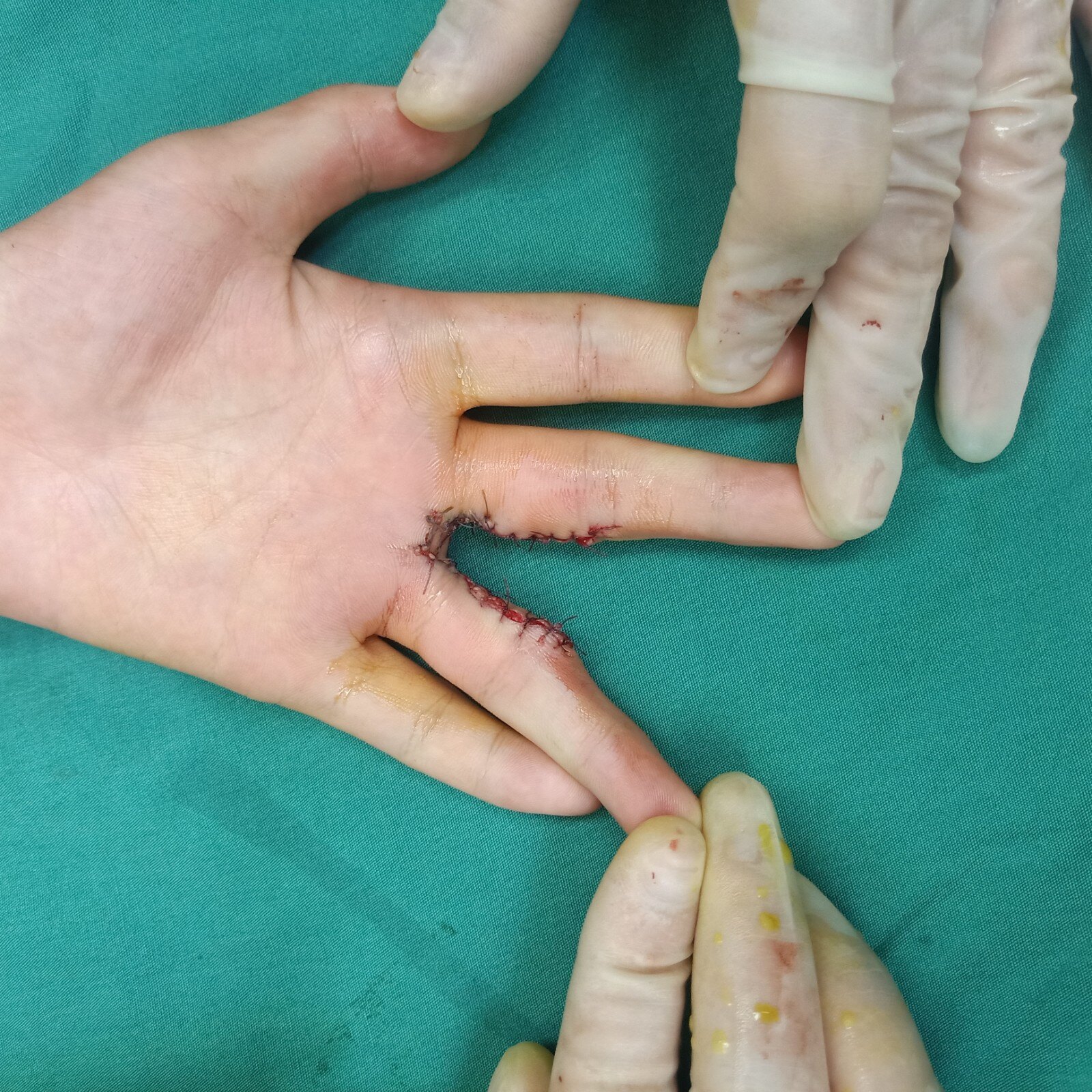 11岁小姑娘左手并指畸形,行左手并指分指松解指蹼重建术.