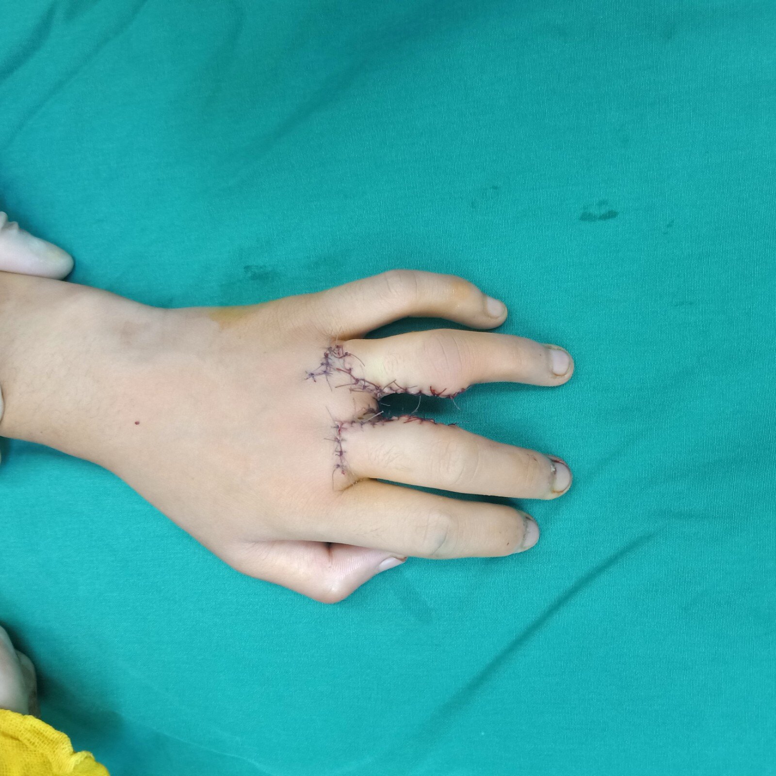 11岁小姑娘左手并指畸形,行左手并指分指松解指蹼重建术