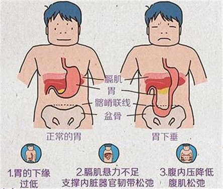胃下垂_介绍_发病原因_症状表现_检查_日常注意事项 - 好大夫在线