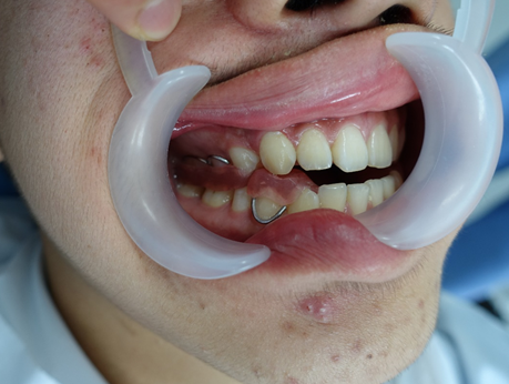 可复性关节盘前移位