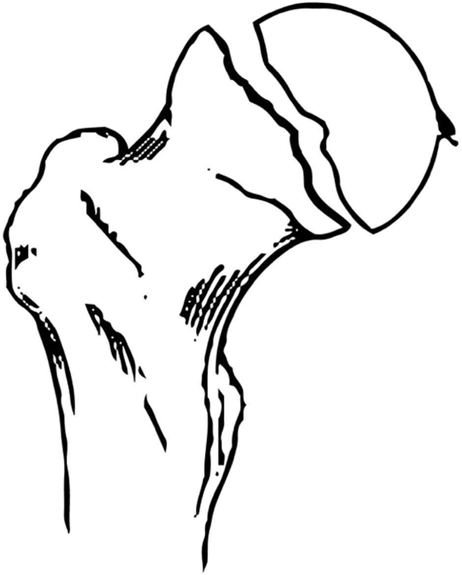 2018年美国华盛顿大学:分类简述:股骨头骨折的pipkin分