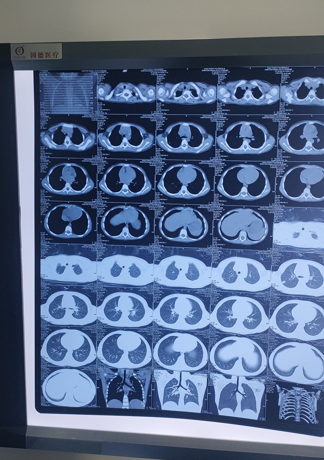 肿瘤片子图片图片