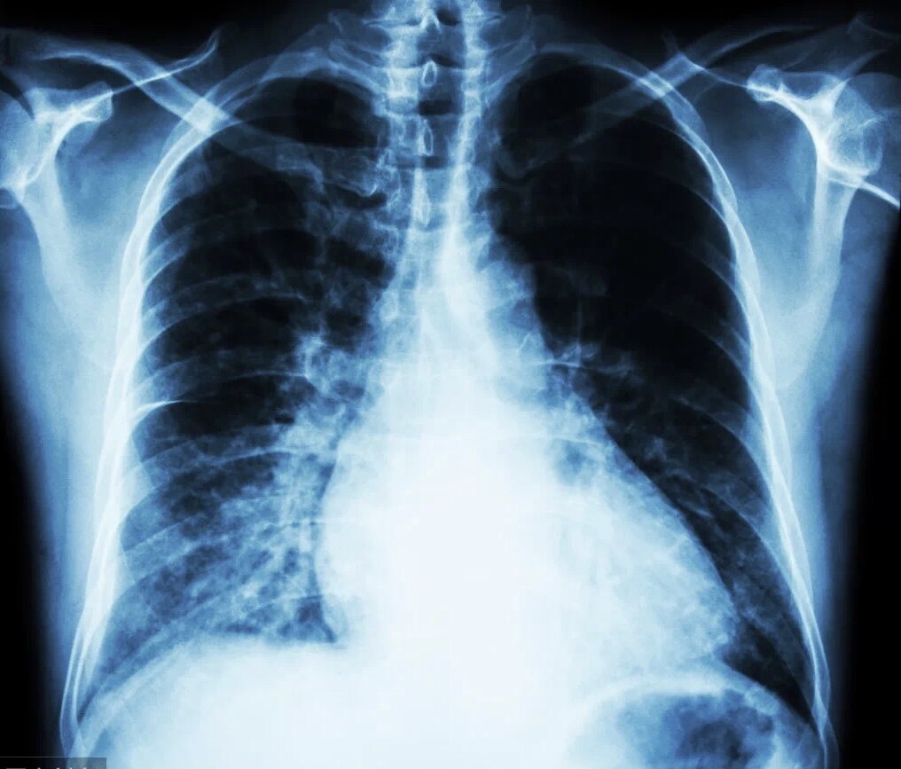 肺癌分期是怎么定的有什么区别吗
