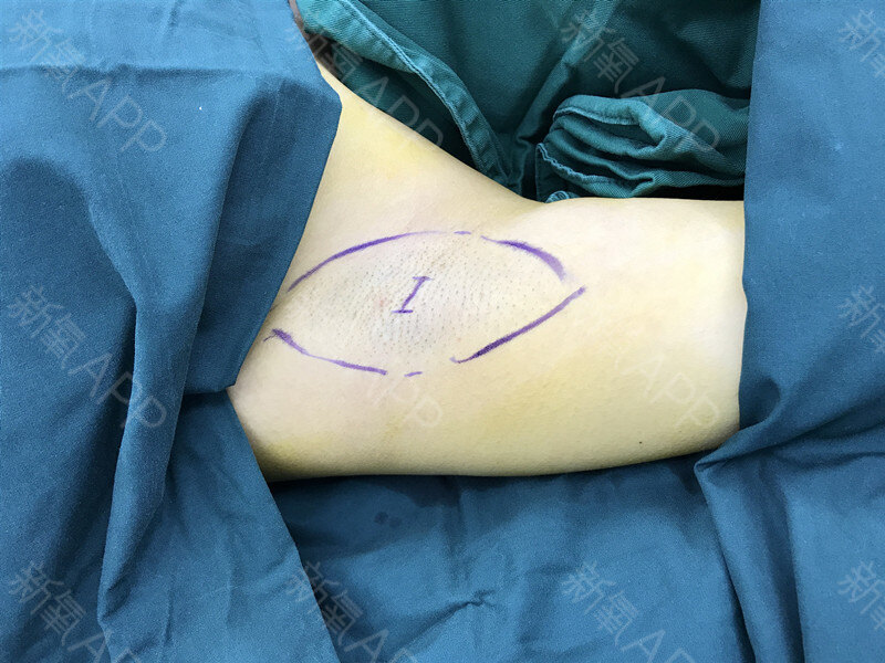 术后即刻图片术后一个月的真实照片,疤痕不明显我们科做腋臭手术的