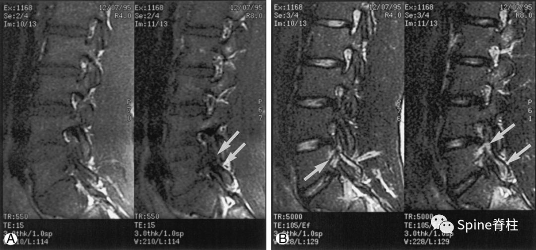 a:t1像,左側腰3峽部呈不連續的低信號(箭頭);b:t2像,左側腰3椎弓根和