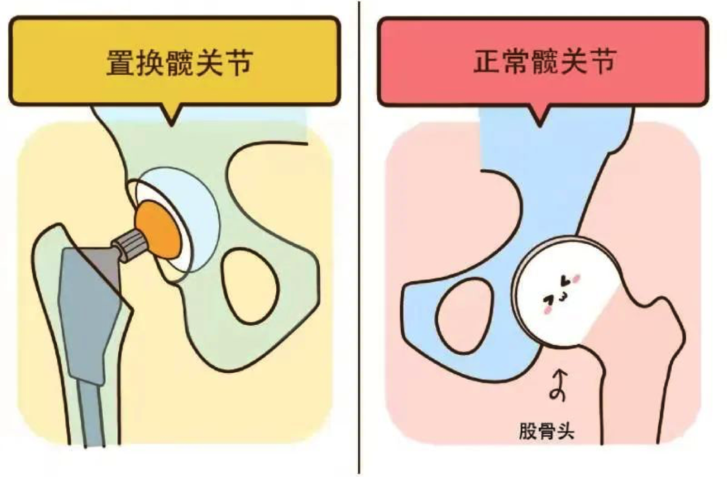在他20岁那年,为了能够重返运动赛场,小伙子接受了右侧全髋关节置换