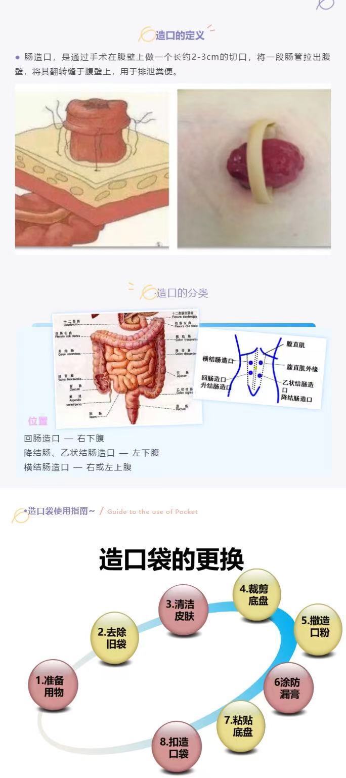 小肠造口术示意图图片