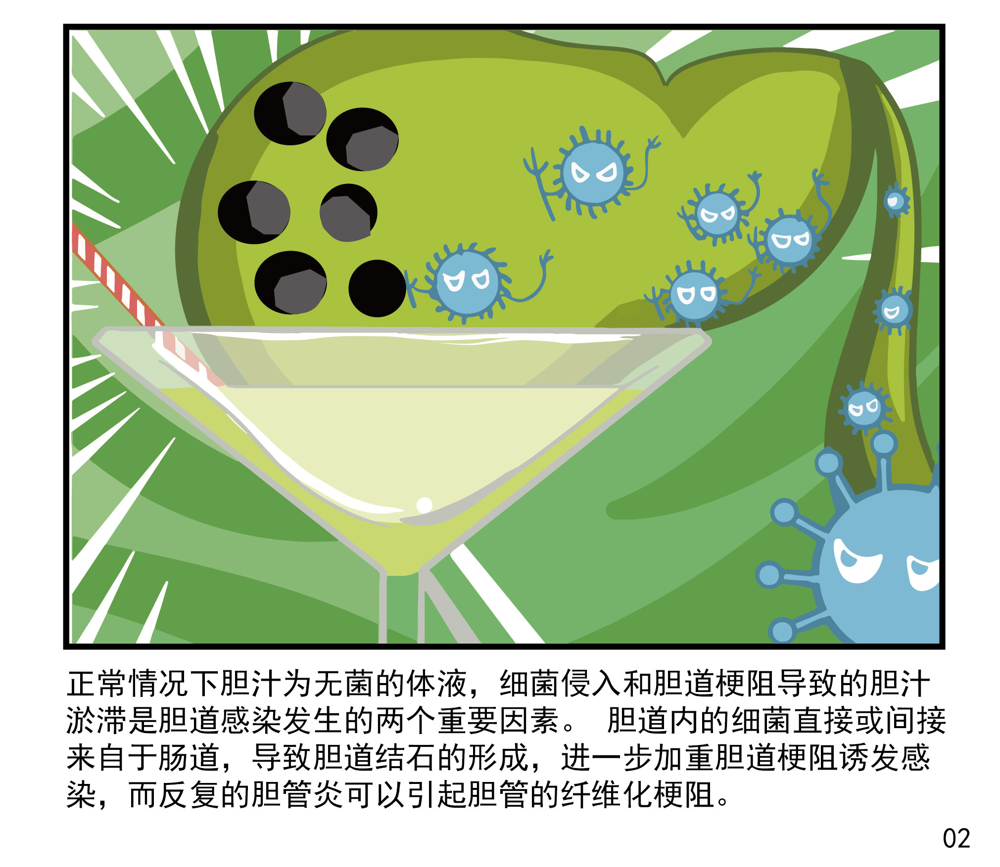 胆囊结石的并发症:胆道感染_胆道感染_发病原因_症状表现_治疗方式