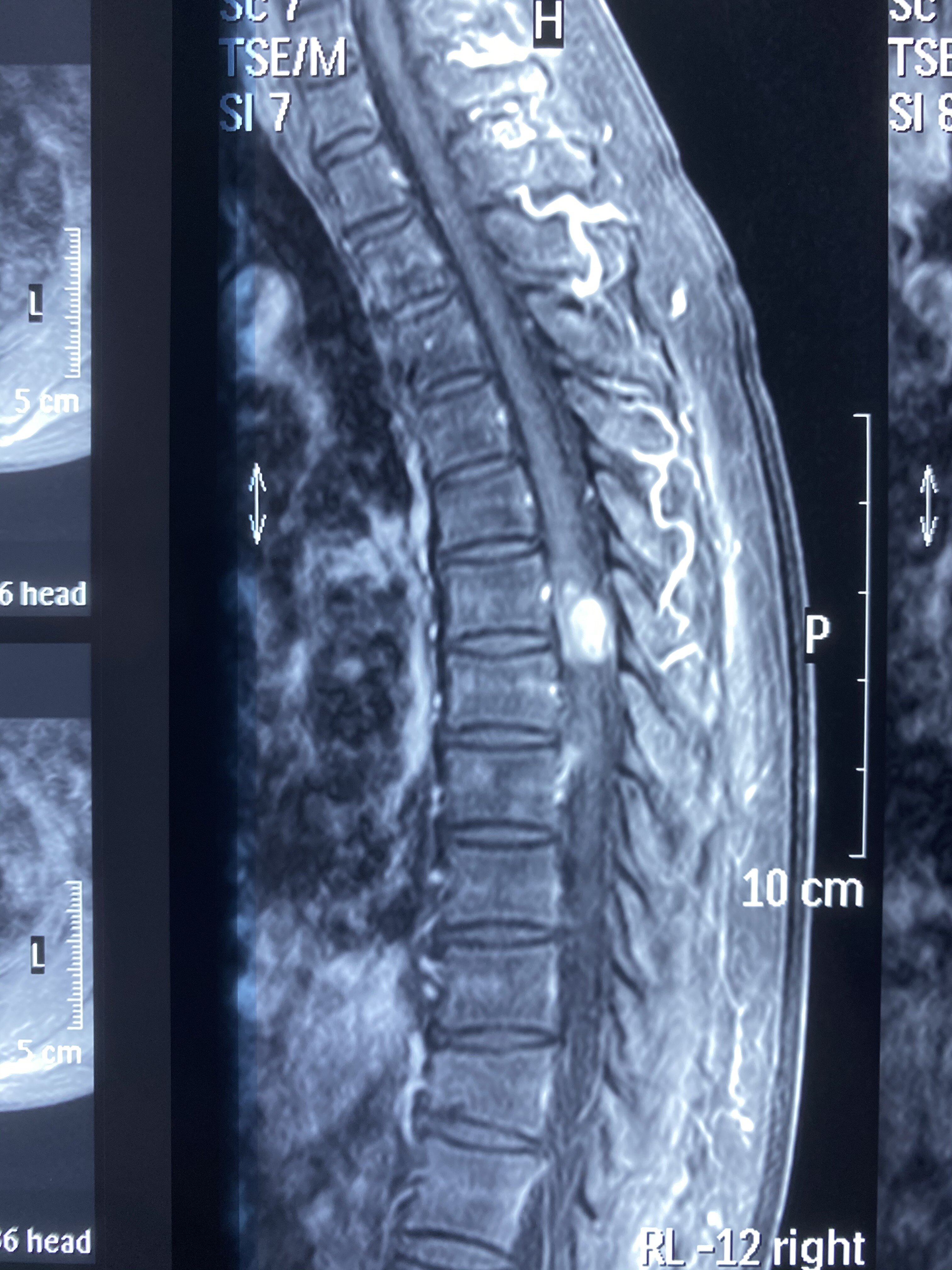 椎管内脂肪瘤图片