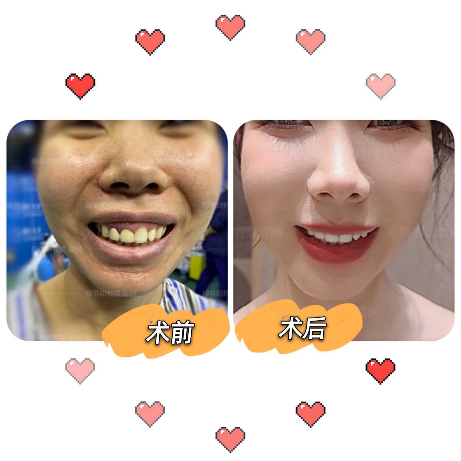 正颌手术案例分享凸嘴露龈笑术前术后对比术后她绽放自信笑容照片为