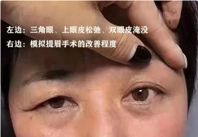 做提眉手術會後悔醫生分享幾個提眉手術的真相