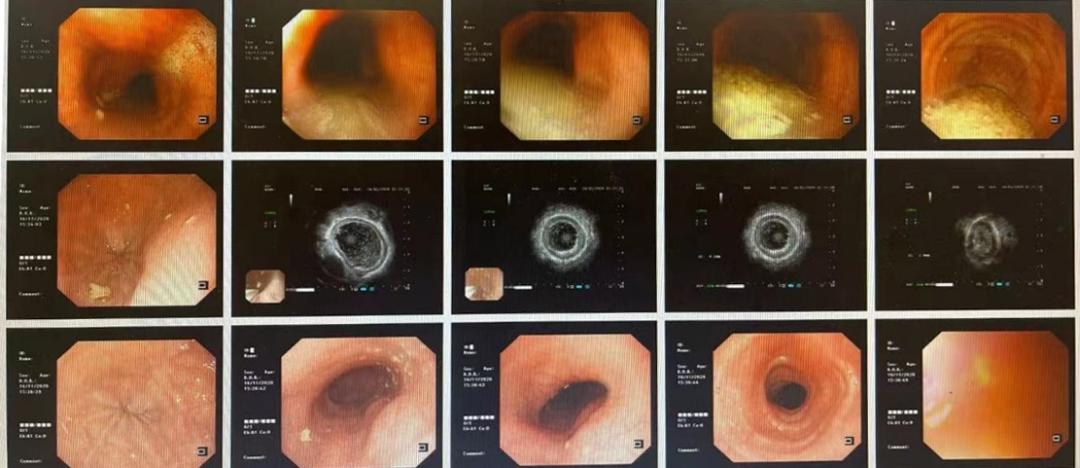 贲门失弛缓症的内镜下治疗 (初治和复治病例)_贲门失弛缓症_治疗方式
