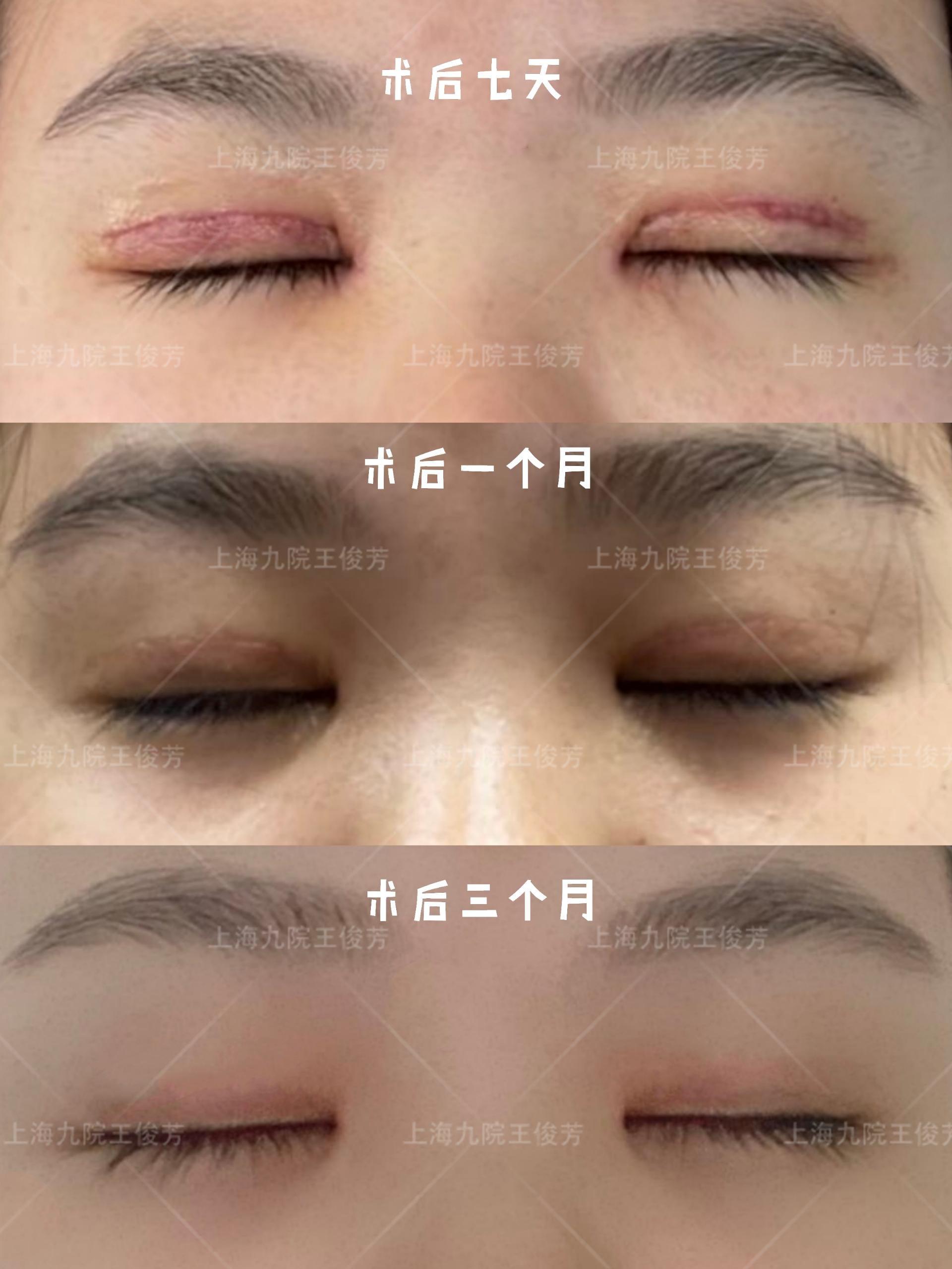 全切双眼皮术后3个月 - 好大夫在线