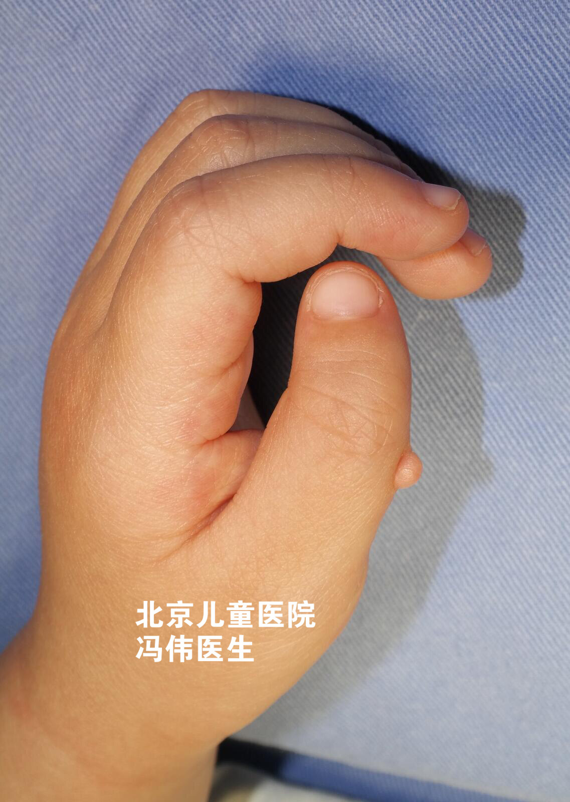 先天性手部畸形与后天性手部畸形治疗_郑州仁济医院
