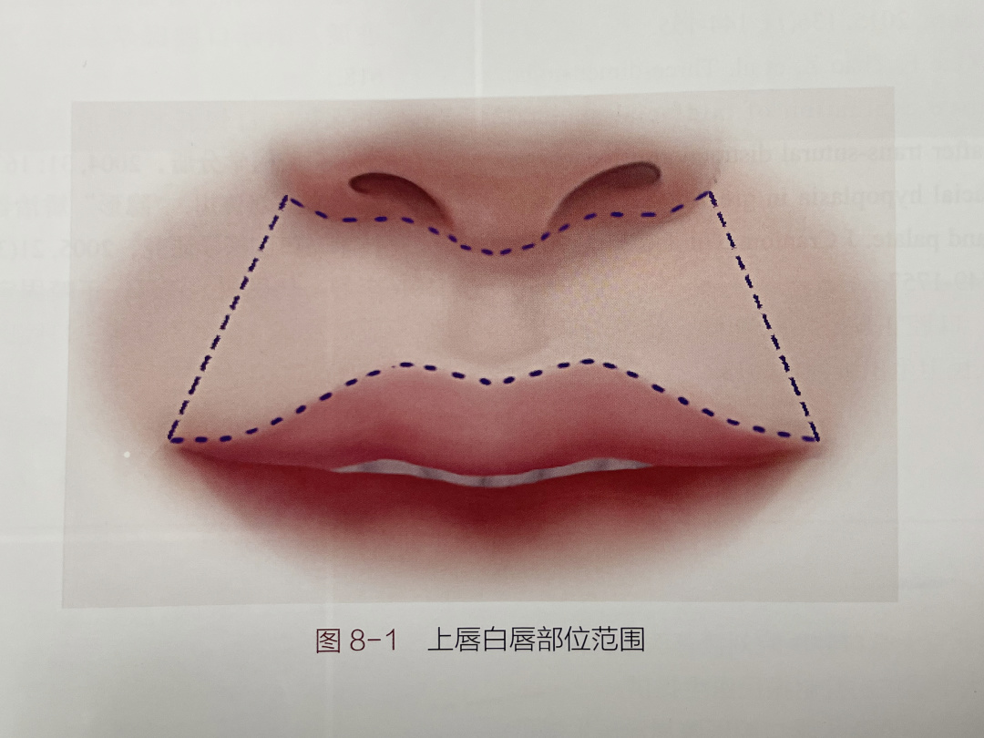 人中是一个重要的软组织美学结构,是上嘴唇的皮肤部分,也叫"唇白",上