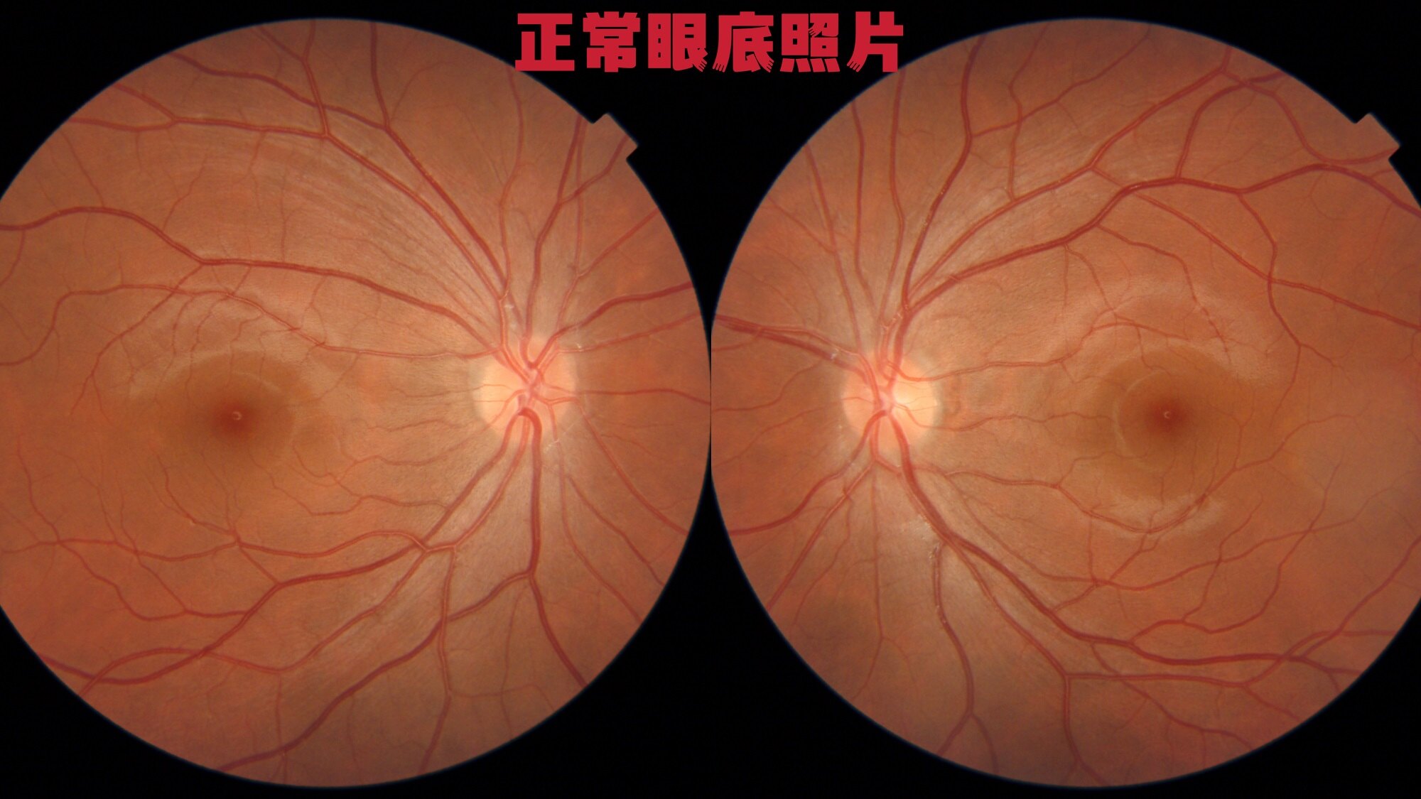 糖尿病视网膜病变是成人首位致盲性眼病,该如何早防早控免失明