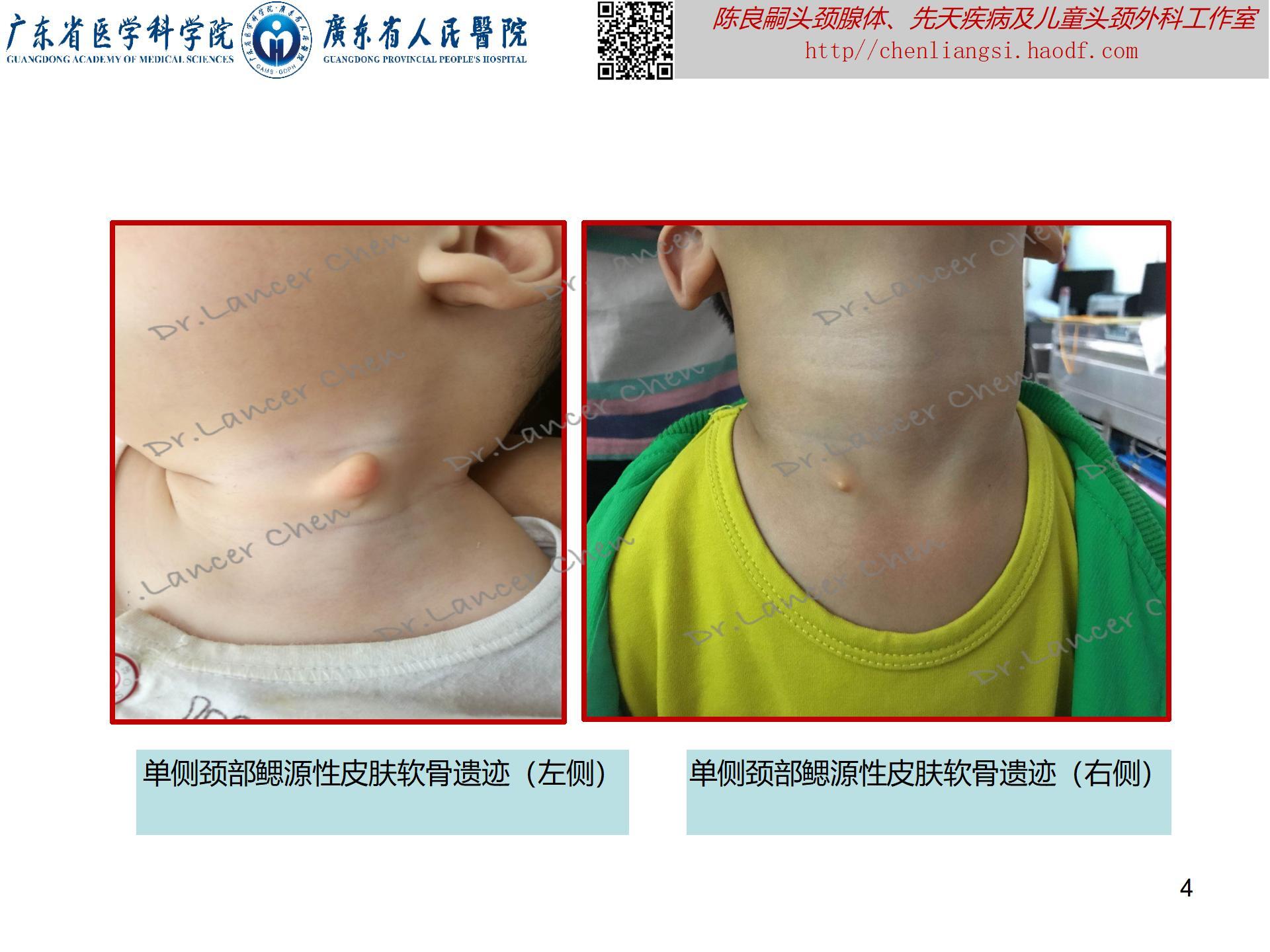 医学科普——颈部鳃源性皮肤软骨遗迹:一种形似山羊脖子上肉垂的 医学科普——颈部鳃源性皮肤软骨遗迹:一种形似山羊脖子上肉垂的