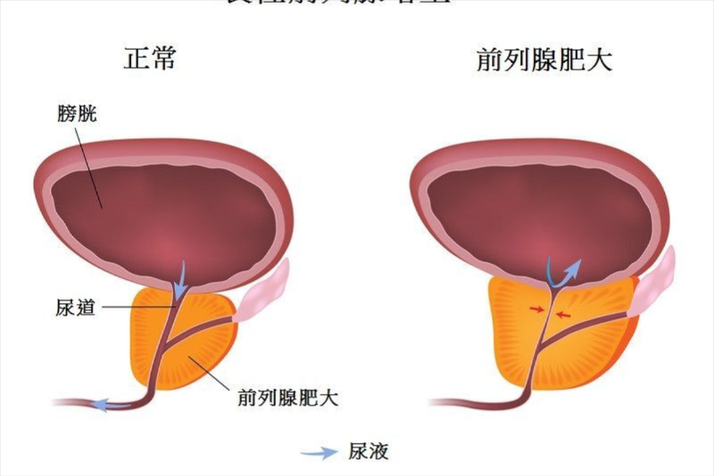 前列腺.jpg