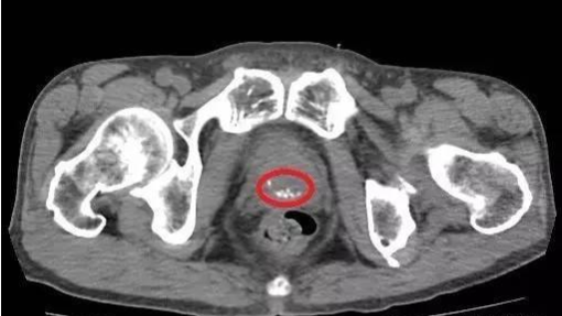 前列腺钙化.jfif