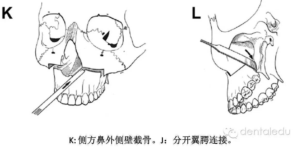 將上頜骨外側壁,內側壁完全切開,分開翼上頜連接及鼻中隔骨性連接,在