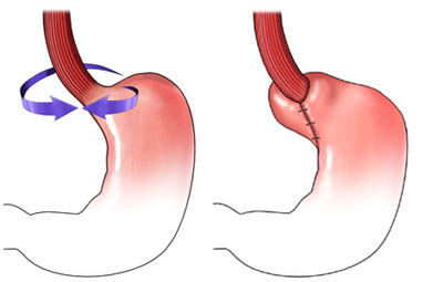 "胃底折叠术"知多少