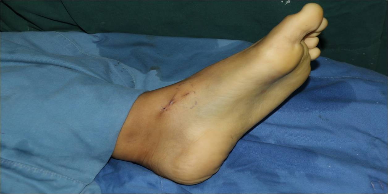 传统的治疗方法为内踝截骨开放手术下行踝关节清理和囊肿刮除植骨