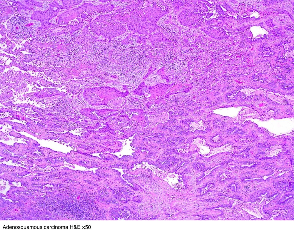 世界卫生组织who定肺腺鳞癌定义为由腺癌和鳞癌组成,且腺癌和鳞癌的组