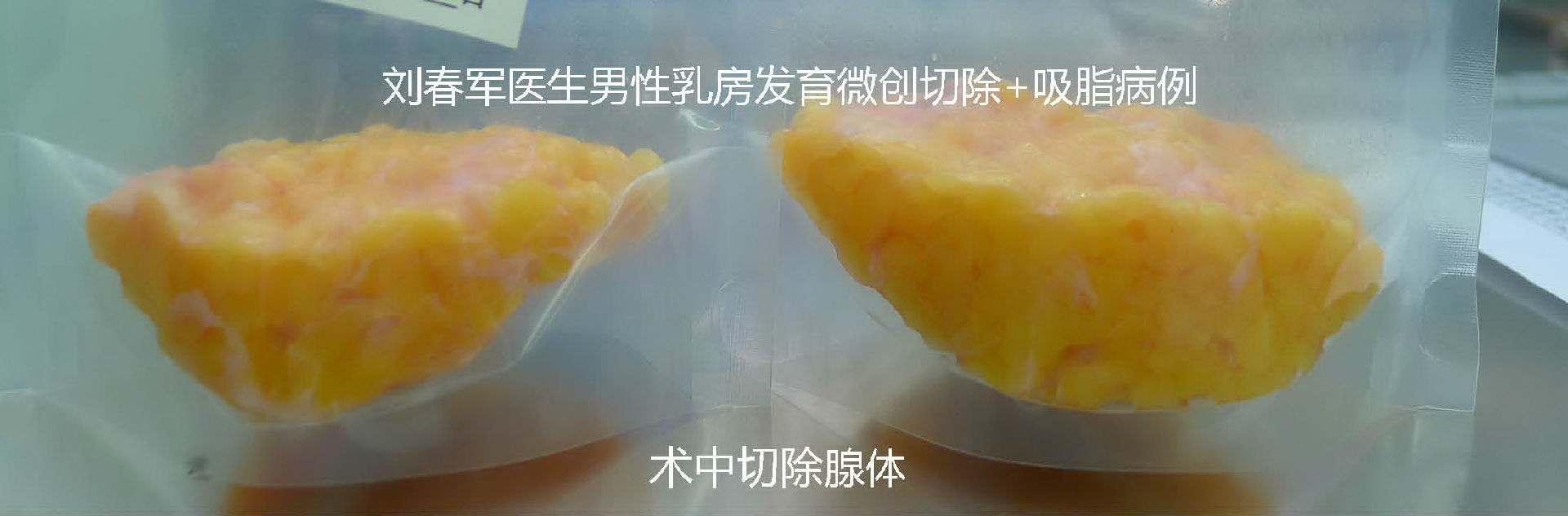 多组病例分析,术前问答与术后护理_男性乳房肥大_手术_ 好大夫在线