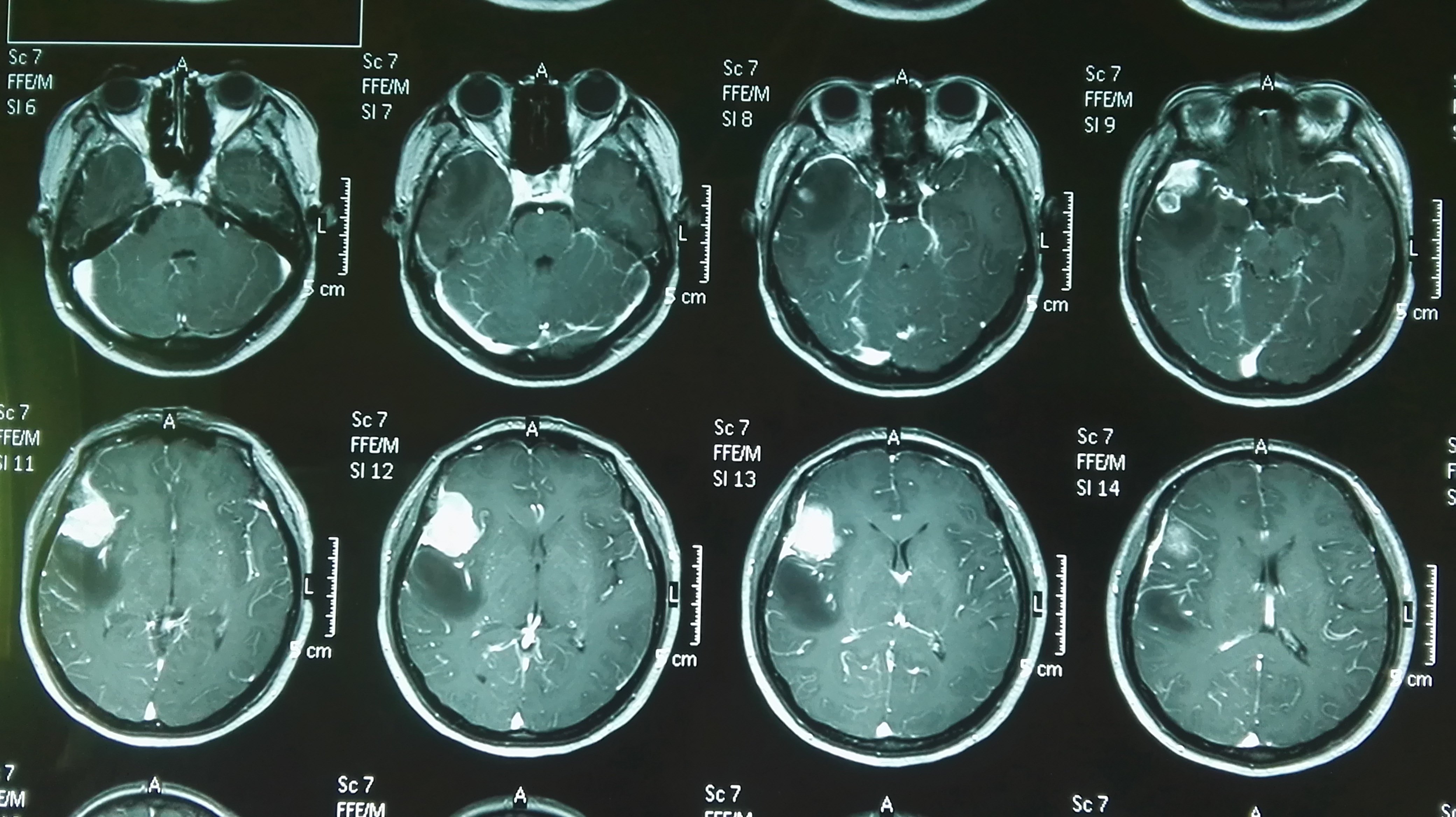 左颞叶脑膜瘤图片
