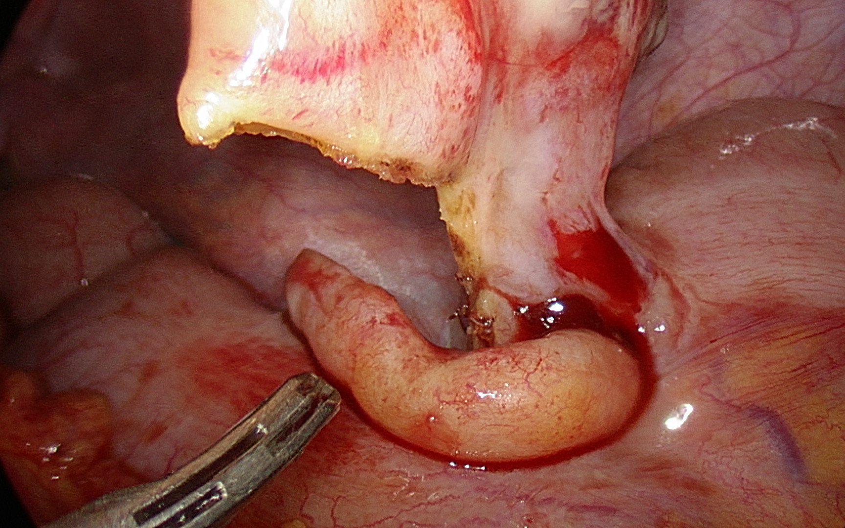 急性坏疽性阑尾炎的腔镜手术一例 