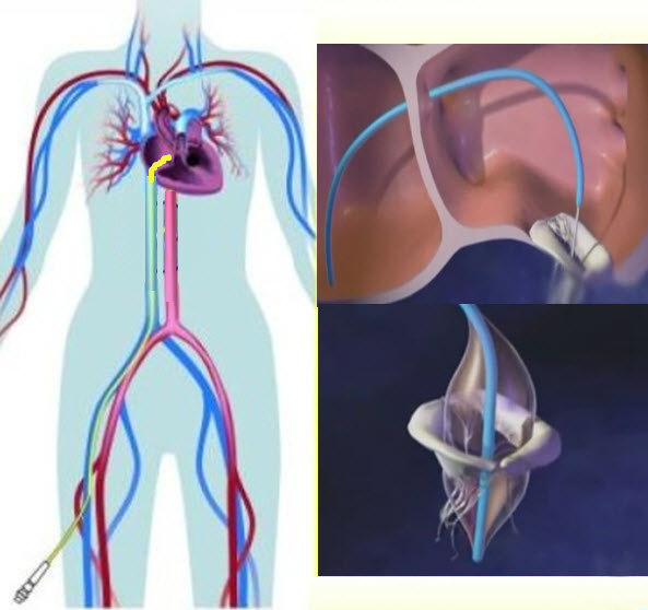 不开刀!不用放射线!治疗二尖瓣狭窄!