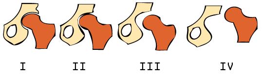 髋关节专家门诊:什么是髋关节发育不良的crowe分型?