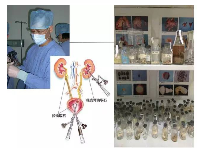 当今体外碎石的临床地位 - 好大夫在线
