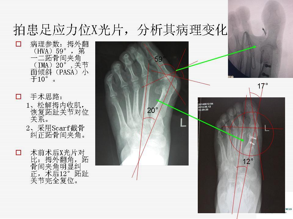 scarf联合akin截骨治疗中重度拇外翻畸形疗效分析