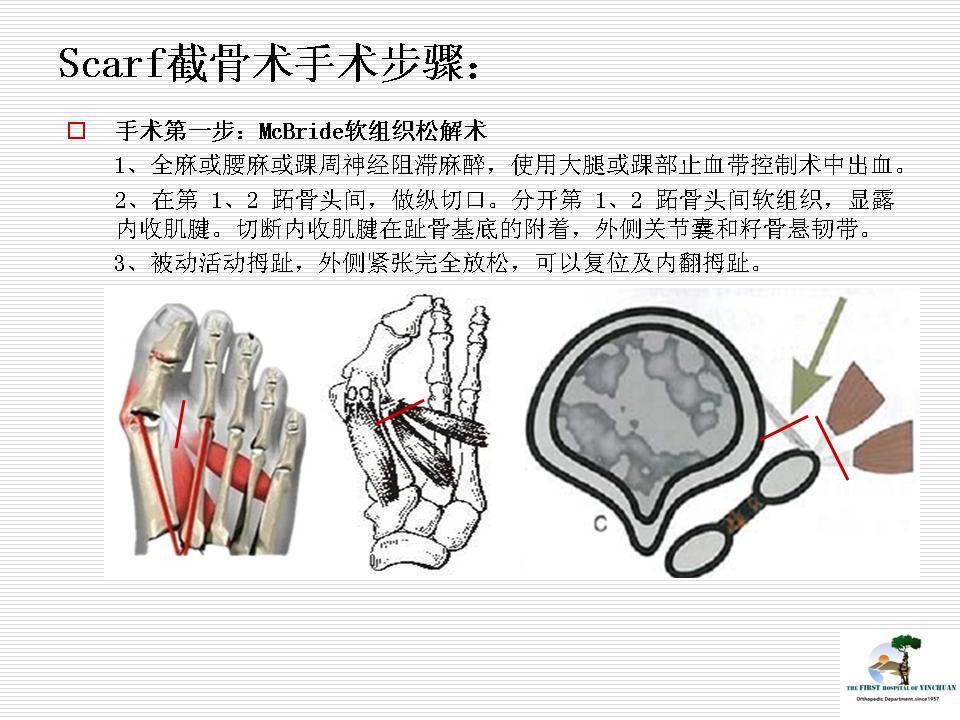 scarf联合akin截骨治疗中重度拇外翻畸形疗效分析