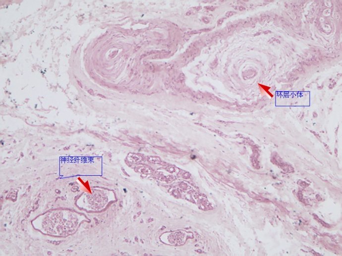 thymic corpuscle图片