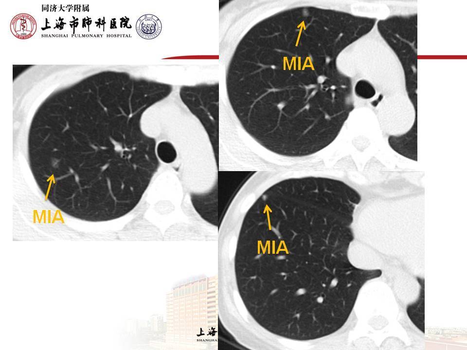 表現為磨玻璃結節/磨玻璃影的微浸潤腺癌(mia)_肺癌_肺癌介紹 - 好