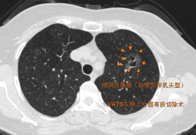 牛眼樣ggo5.花瓣樣的ggo4.荷包蛋型3.支氣管充氣徵2.胸膜凹陷1.