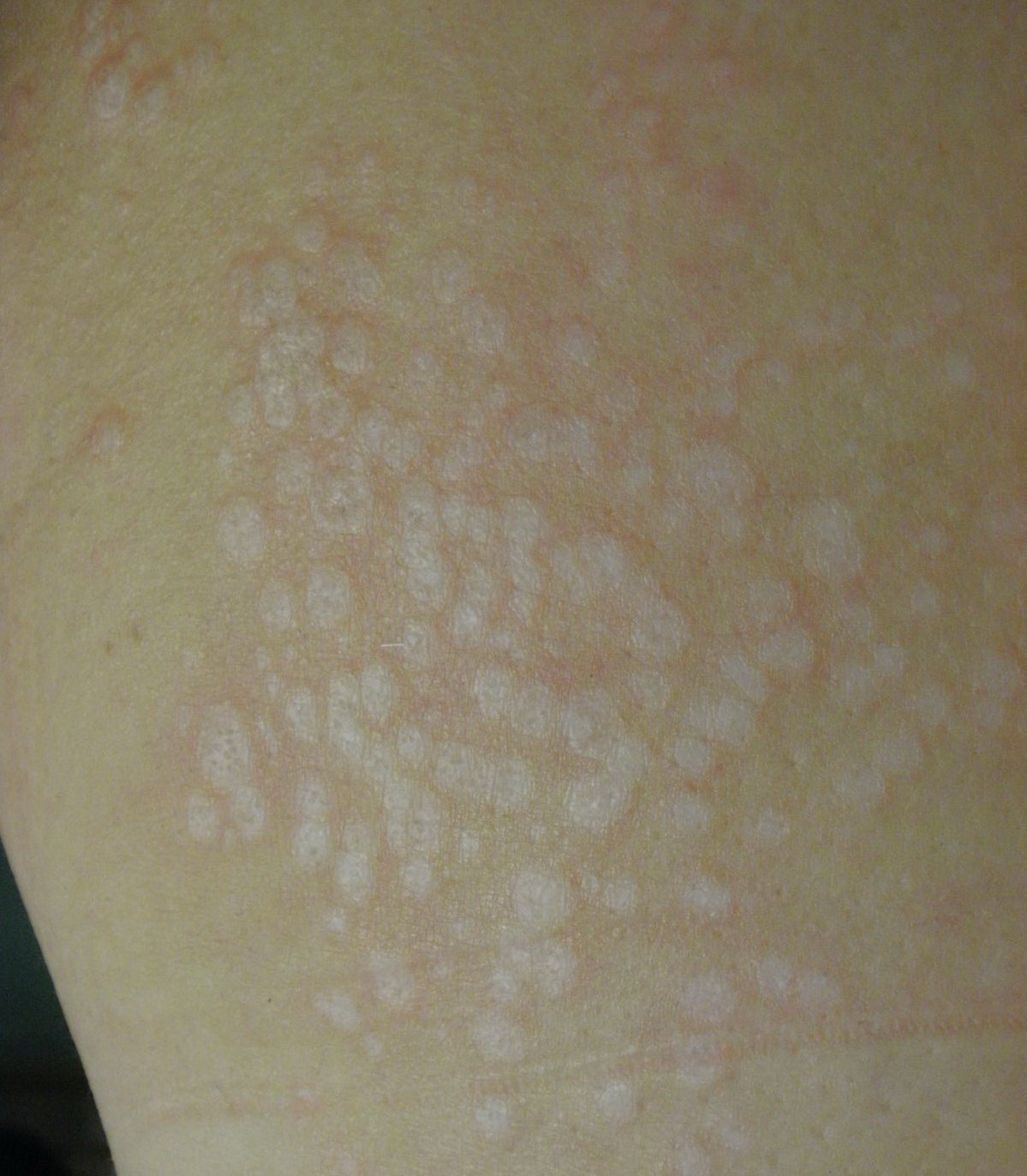 医院找医生 按疾病找医生 首页 疾病知识 下载客户端 桐乡市皮肤病防