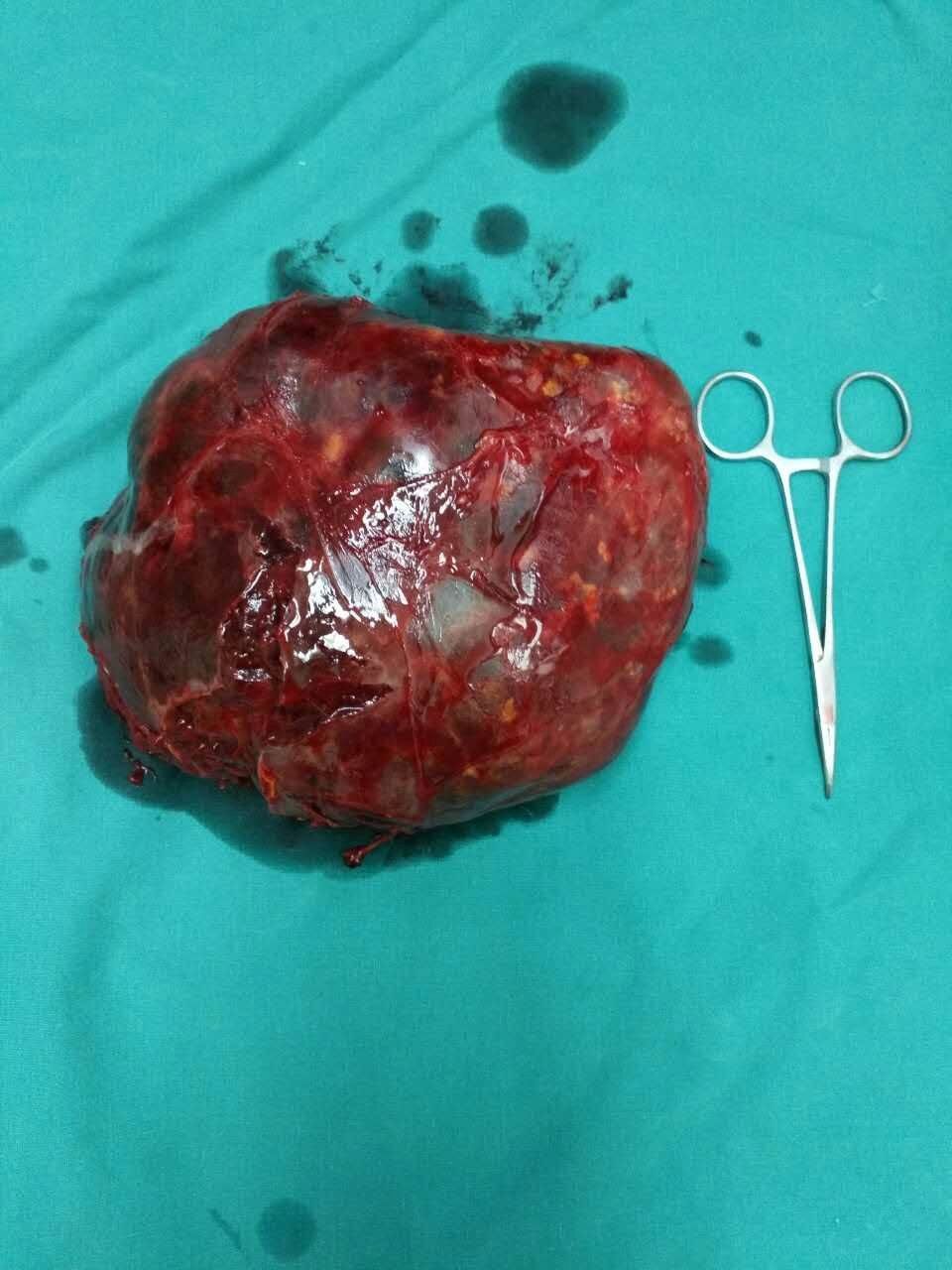 右侧巨大肾上腺肿瘤切除术