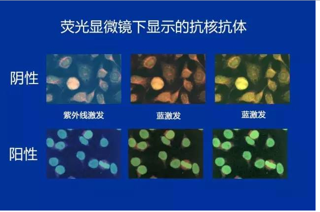 類風溼關節炎的化驗單應該這麼看