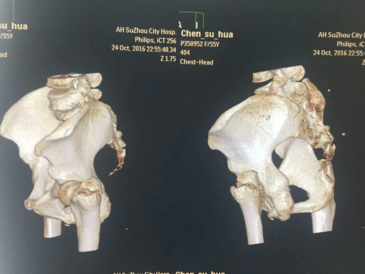 这个病人大转子要一起固定吗,怎么固定? 