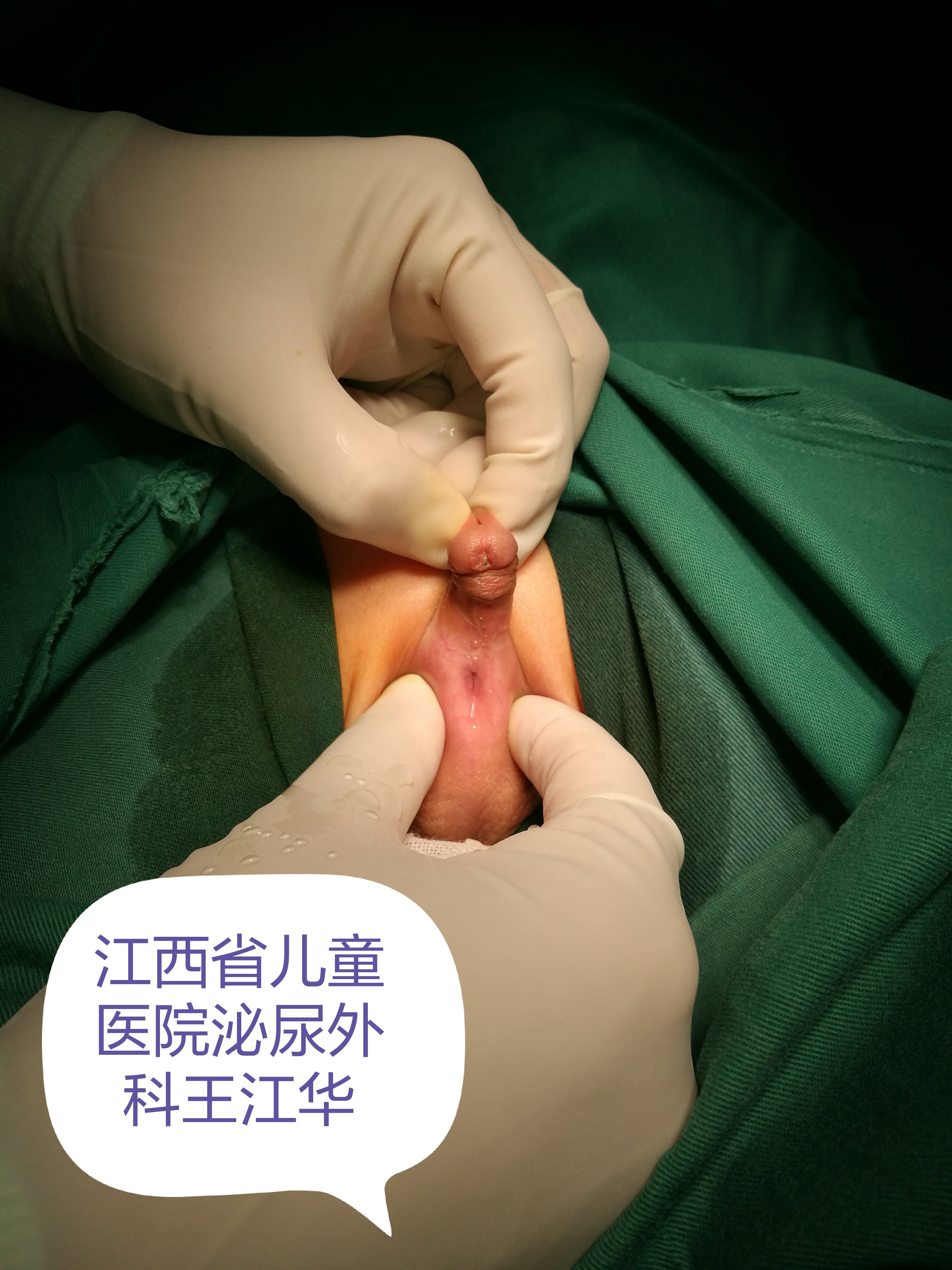 尿道下裂 男孩排尿不在小鸡鸡顶端怎么办 尿道下裂 疾病介绍 治疗方法 好大夫在线 尿道下裂 男孩排尿不在小鸡鸡顶端怎么办 尿道下裂 疾病介绍 治疗方法 好大夫在线