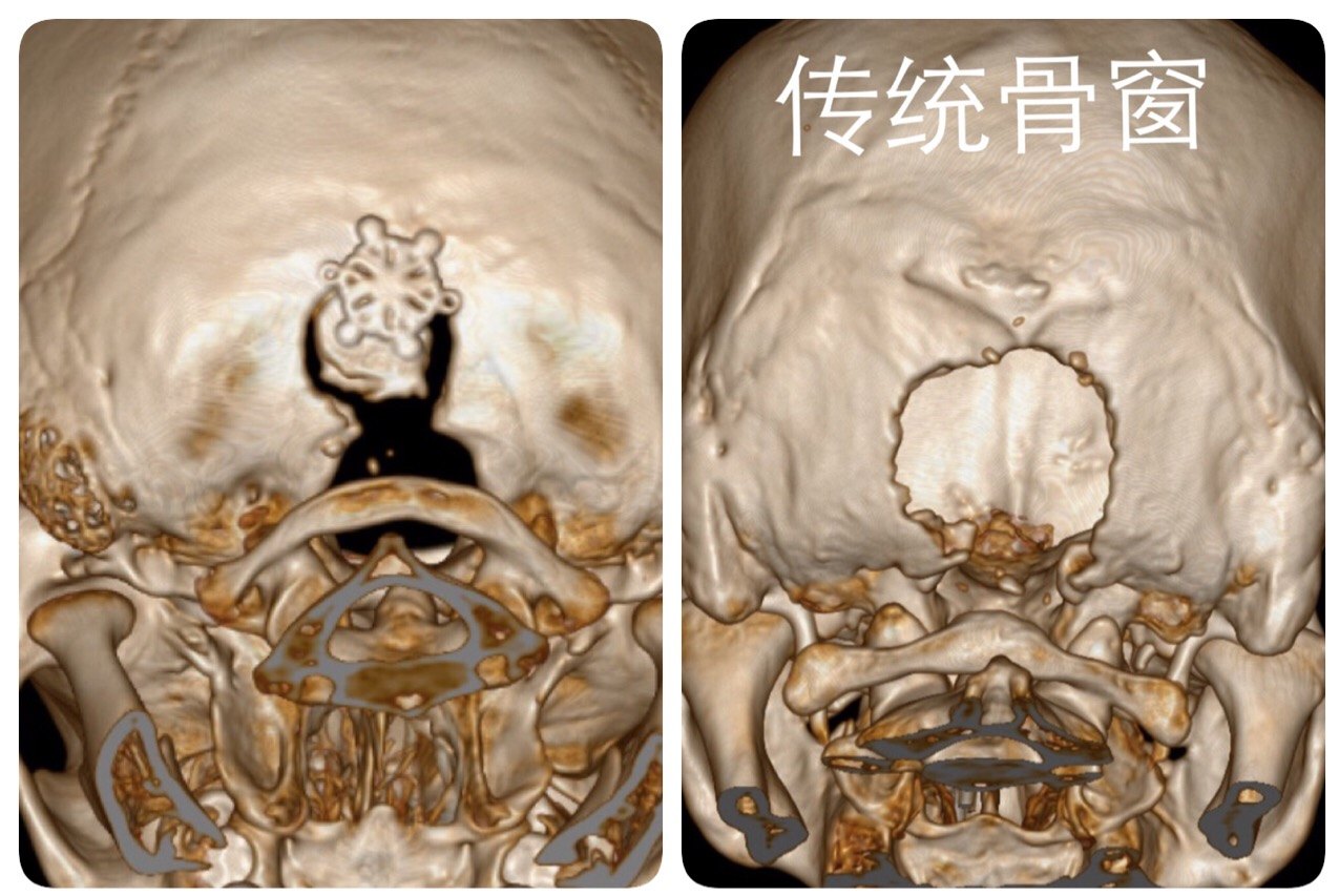 微創鎖孔切除髓母細胞瘤竇以河青大附院