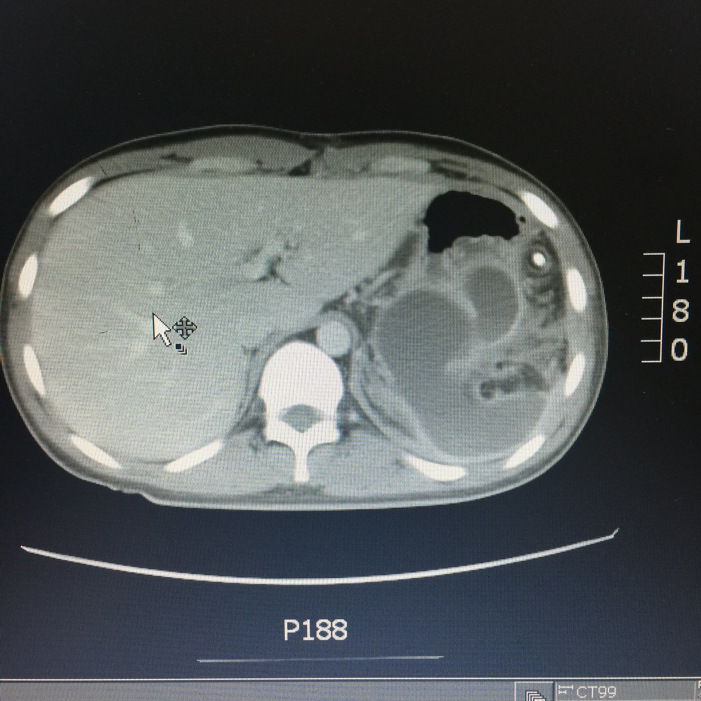 胰腺断裂后囊肿后背穿刺引流控制胰漏感染 - 好大夫在线