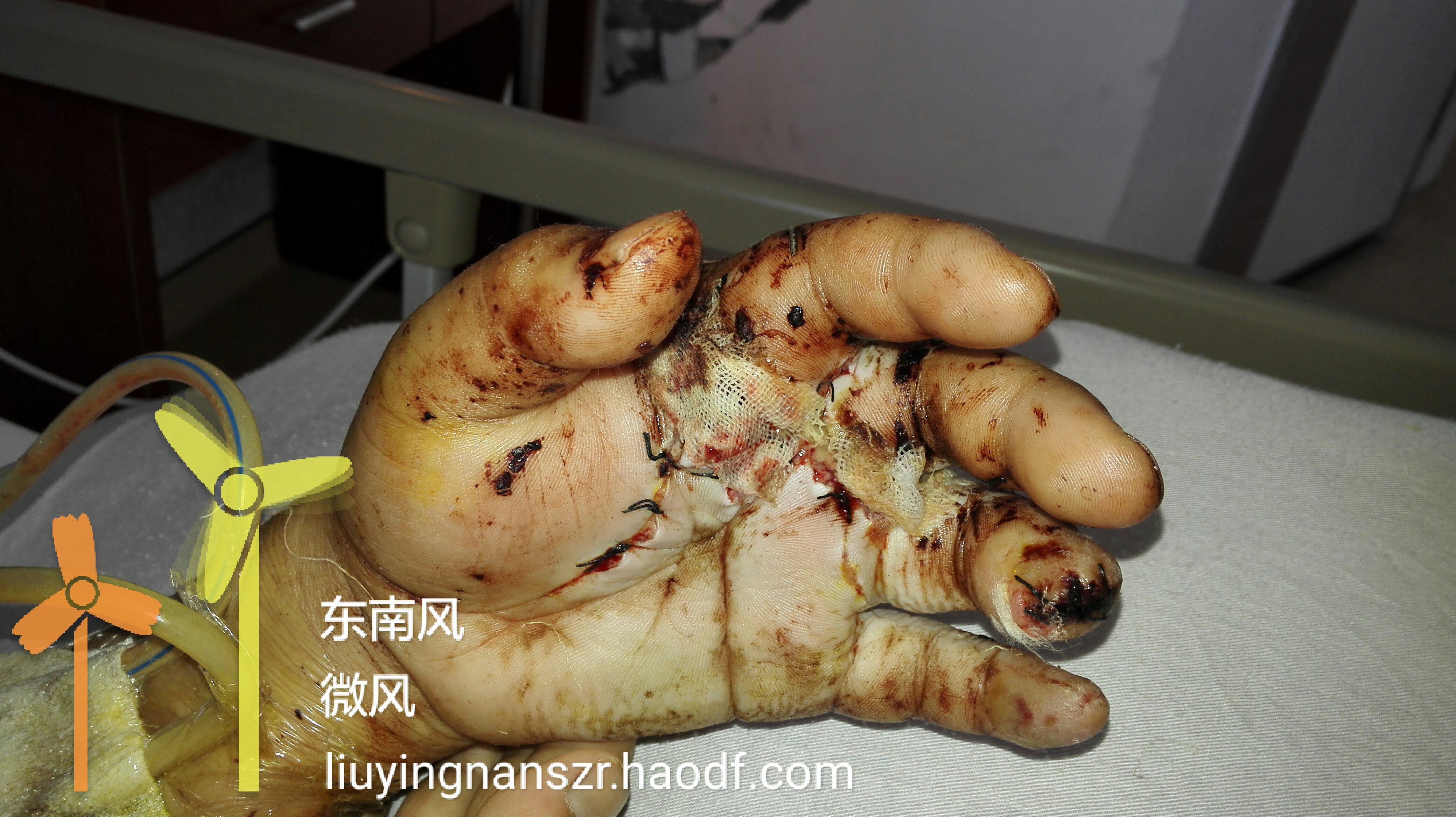 主刀复杂撕脱离断伤再植成功 - 好大夫在线