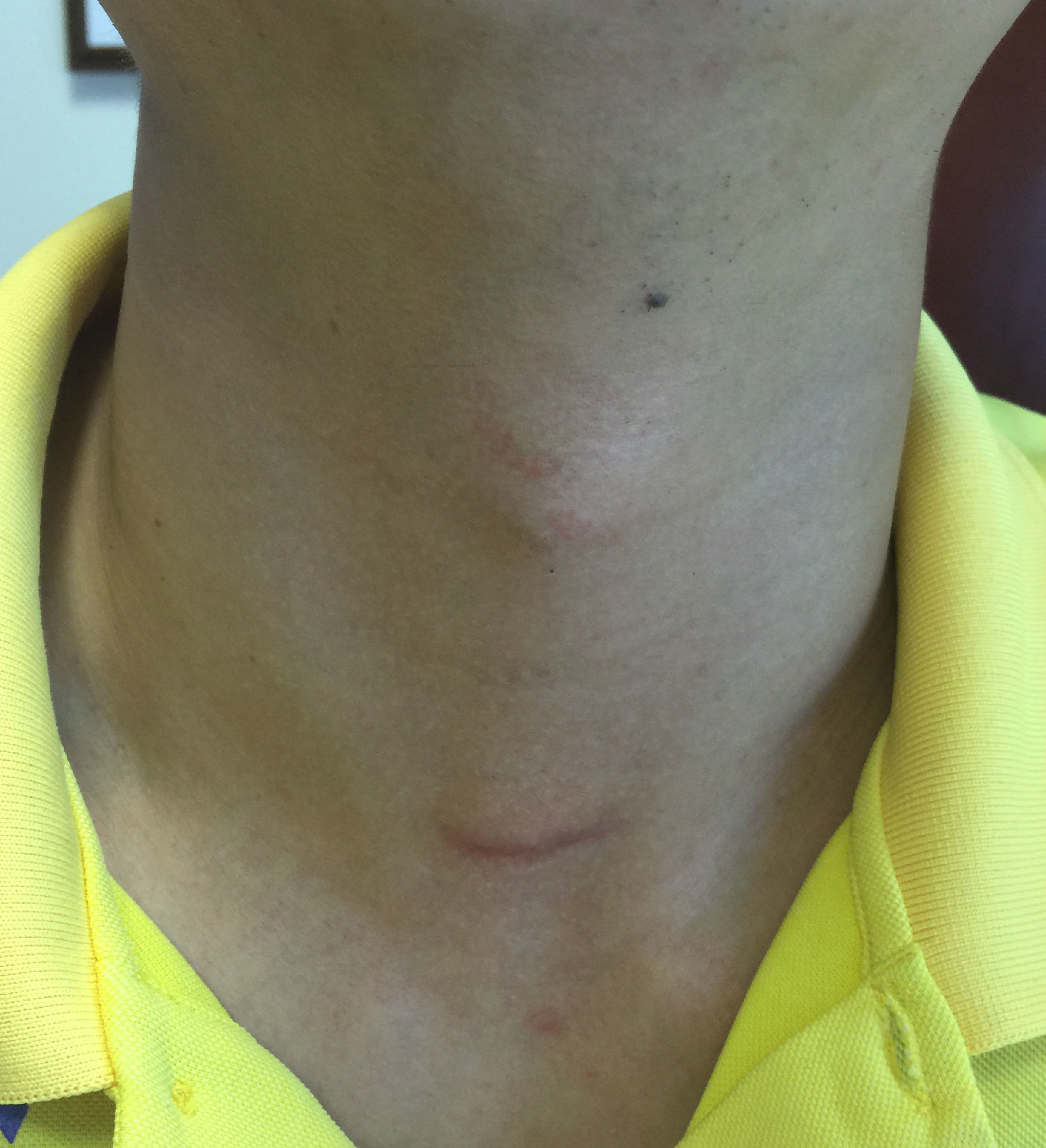 另一例内镜辅助甲状腺癌手术后切口