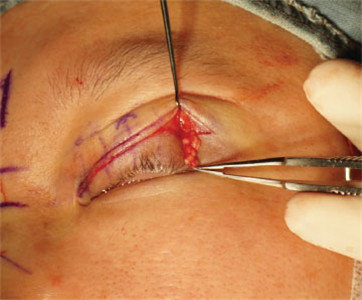 泪腺脱垂手术过程图片图片