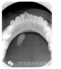 进食后肿胀需小心颌下腺结石病 症状 日常护理