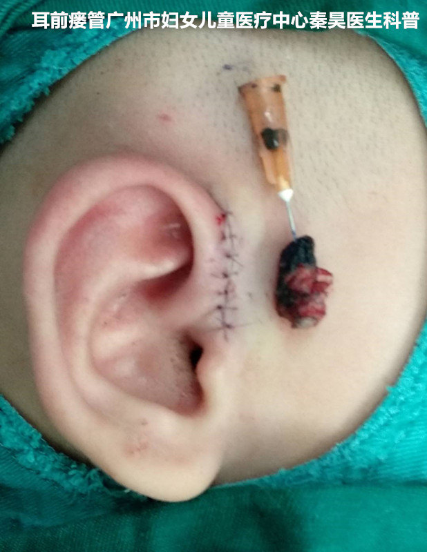 先天性耳前瘘管科普 解答几个患者最关心的问题 先天性耳前瘘管 疾病介绍 手术 日常护理